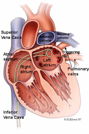 How successful is AF ablation?