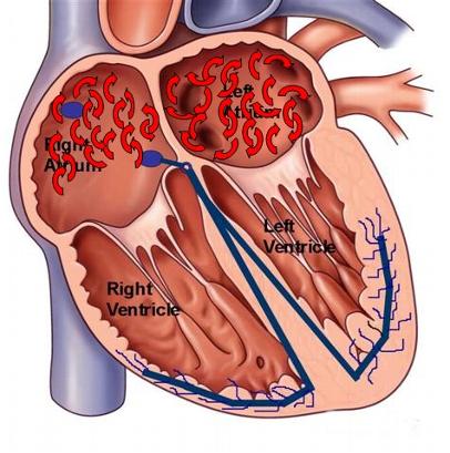 AFib