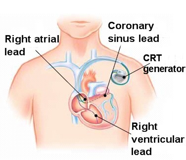 cardiac resynchronization therapy