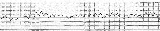 EKG-VF