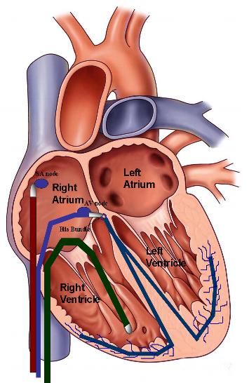 catheter-ablation-for-arrhythmias-washington-dc-maryland