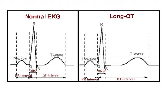 long-qt-syndrome