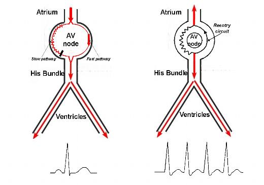 av nodal reentrant tachycardia