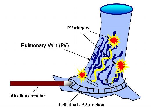 PVI-ablation