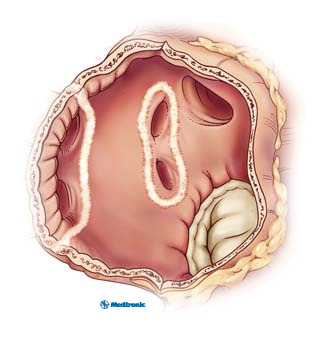 PulmonaryVeinLesions