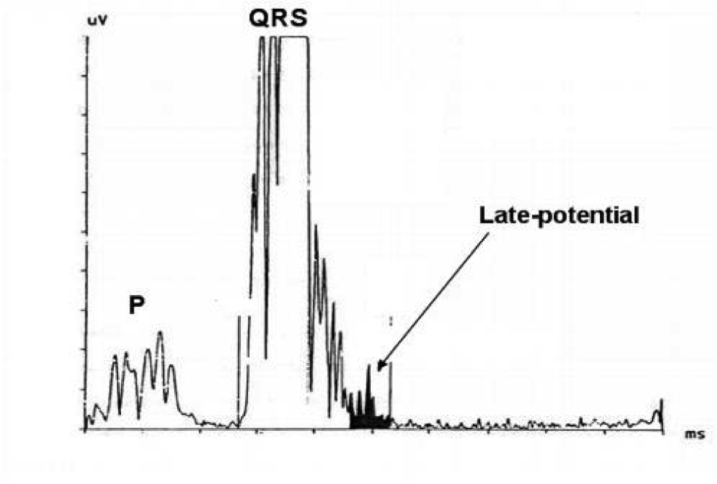 Signal-Averaged-EKG