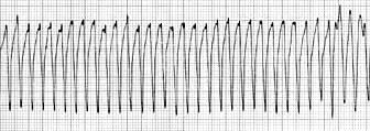 VT-EKG