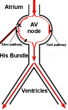 av nodal reentrant tachycardia