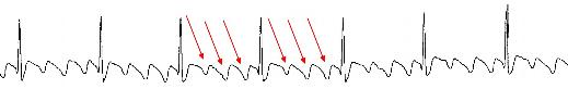 atrial-flutter-strip