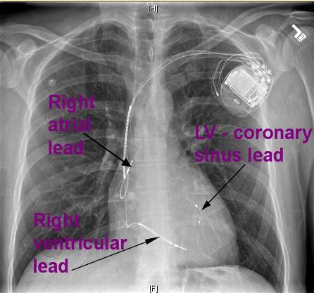 cardiac resynchronization therapy