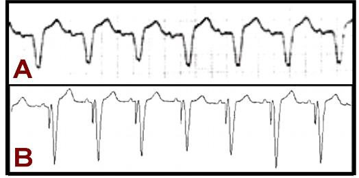 cardiac resynchronization therapy ecg