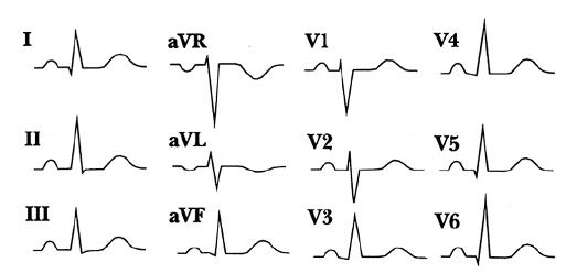 normal 12 lead ecg labeled