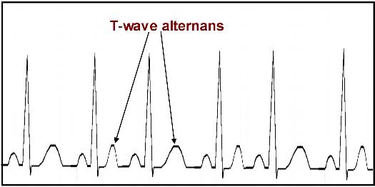 t-Wave-Alternans-TWA