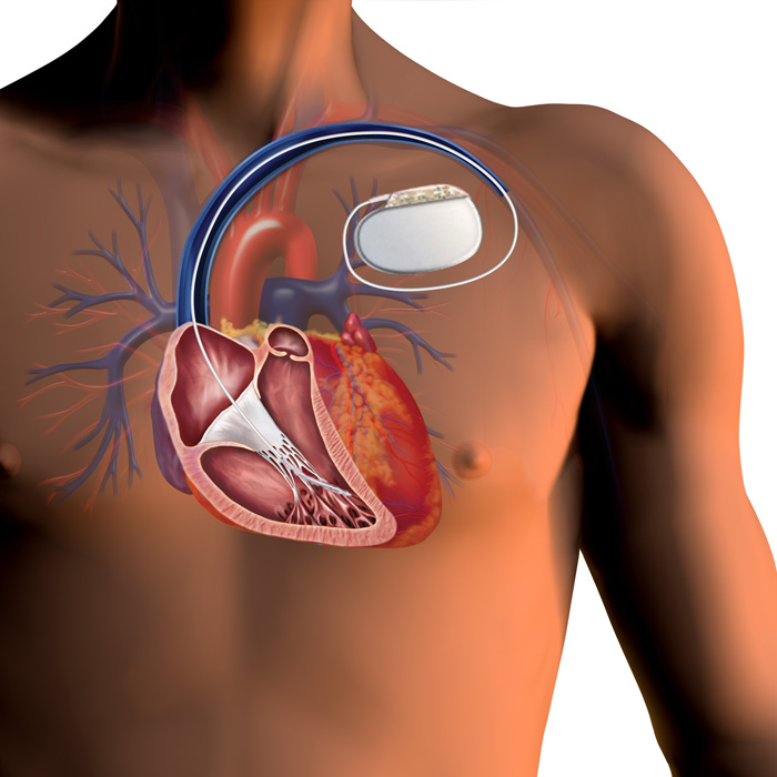 implantable cardioverter defibrillator medtronic