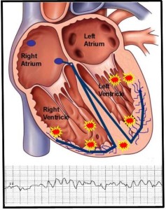 Implantable Cardioverter defibrillator (ICD), Washington DC & Maryland